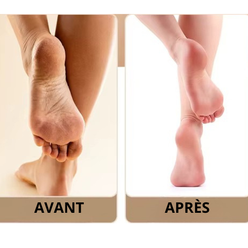 SoftHeel™ – Éliminateur de callosités sans douleur